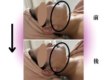 カリアンヌ/NMNフェイシャル/リフトアップ