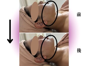 カリアンヌ/NMNフェイシャル/リフトアップ