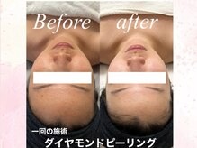 カラン(Calin)の雰囲気（角質ケアの１回での症例です♪）