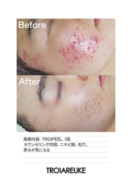 リベレ(Libelle)/ニキビにお悩みの方