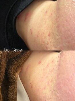ビーグロウ(be Grow)/TIPハーブピーリング