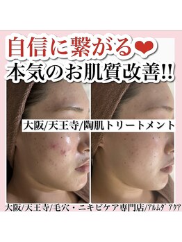 アルムダアクア 天王寺店(Aleumda AQUA)/大阪/天王寺/ハーブピーリング
