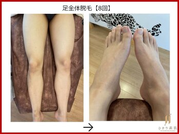 ひかり素肌/足脱毛8回