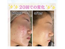 ハイファイブ(Hi-Five)/ポテンツァ/（施術20回）