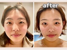 エヴァル 久留米店(ewalu)/温熱小顔リフト