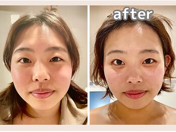 エヴァル 久留米店(ewalu)/温熱小顔リフト