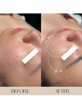 インフィニーズ(INFINEEZ)/カスタマイズ90分毛穴改善20代