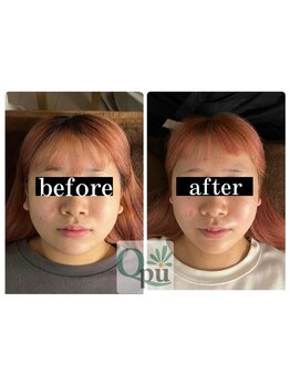 キュープ 群馬吉岡店(Qpu)/お顔の余白をスッキリ！