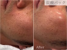 ケリーズ(KELLY `S)/保湿力アップ毛穴ケアエステ