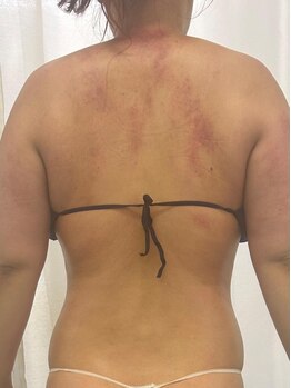 プラスワン(PLUS ONE)の写真/【本気で痩せたい結果重視の方に】痛さは地獄級!?でも施術後はスッキリ、ハミ肉撃退☆効果は口コミをcheck!