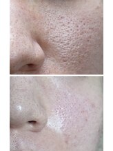 晴(haru)/ハーブピーリング