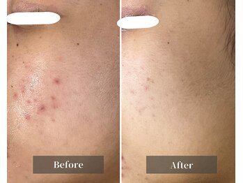 エミルカ 天王寺店(EMILUCA)/ニキビの肌質改善