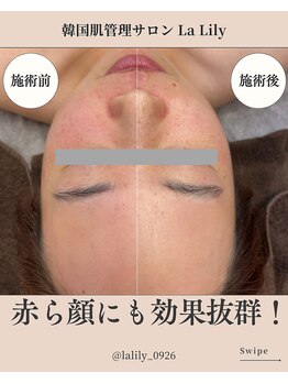 ラリリー(La Lily)/赤ら顔も改善!乾燥の時期に