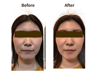 フェルナ(FERNA)/Before/After