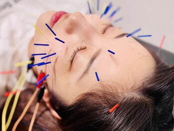 桐生ひろさわ整骨院/美容鍼4