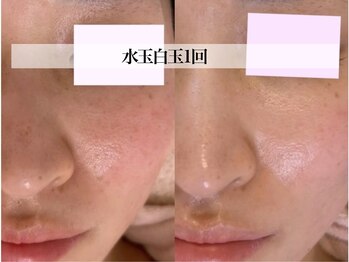 サロンヴェアリー 広尾(salon vary)/恵比寿広尾｜赤み・ヒリつきに