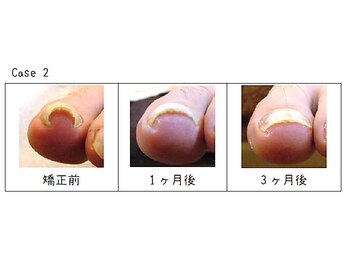 東京巻き爪センター 本院 麻布十番/巻き爪症例画像【東京/巻き爪】