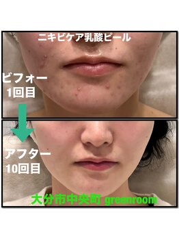 グリーンルーム(green room)/ニキビケア10回目