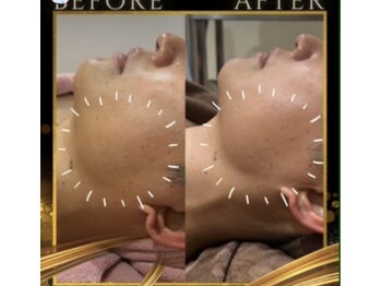 ラフィール/メンズ小顔：圧倒的効果実感