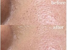 ラティエル(Latiele)/その黒ずみ、産毛かも！