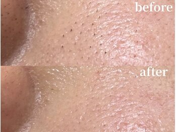 ラティエル(Latiele)/その黒ずみ、産毛かも!