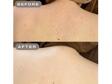 ガーオガーオ 新宿 四ツ谷(GaaoGaao)/ハーブピーリング/背中/5回目