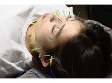 おざき鍼灸整骨院 美容鍼灸サロンOZAKI 西宮北口店の雰囲気（お顔に鍼を打っていきます♪鍼に電気も流しリフトアップ効果◎）