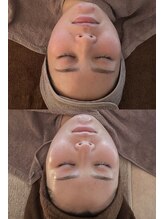 サロンリンセ(Rinse)/人気No.1☆ハーブピーリング