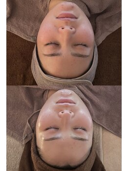 サロンリンセ(Rinse)/人気No.1☆ハーブピーリング