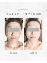 エステサロン JJシャンハイ/ウルトラヒートリフト　施術例