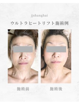 エステサロン JJシャンハイ/ウルトラヒートリフト　施術例