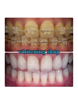 ホワイトニングショップ 所沢店/before&after美白ホワイトニング