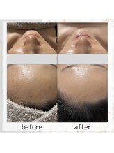 ホワイトニングショップ 広島店(WHITENING SHOP)/【ハーブピーリング】