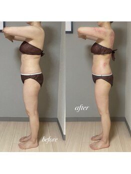 エヌボーテ(N. beaute)/全身痩身コース2回目