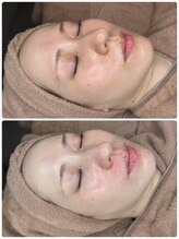 ルアナ(LUANA。)/ララピール☆ビフォーアフター