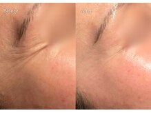 シューラディアント(ShuRadiant)/プラズマフェイシャル