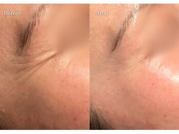 シューラディアント(ShuRadiant)/プラズマフェイシャル