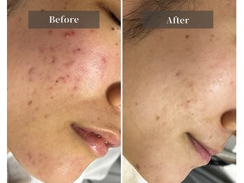 エミルカ 天王寺店(EMILUCA)/凸凹・ニキビもつるんと