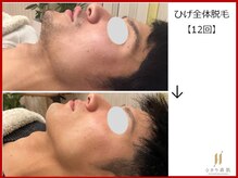 ひかり素肌/ひげ脱毛12回