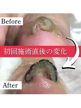 巻き爪矯正センター 沖縄 宜野湾/巻き爪矯正　ビフォーアフター