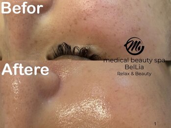 ベリア 広尾(BelLia)/肌改善★幹細胞ハーブピーリング