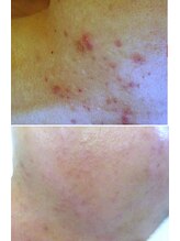 サロンドエステケイワイ(de KY)/フェイシャル☆長年のニキビ改善