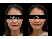 小顔効果◎たるみの根本から改善！