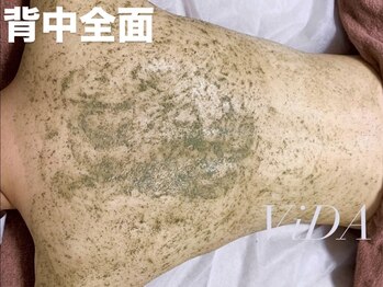 ヴィーダ 渋谷松濤(ViDA)/REVI背中ハーブピーリング