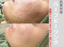 アシュレ リル 西多賀店(assure Lilou)の雰囲気（様々な肌悩みに！話題のハーブピーリングがお得に通えます。）