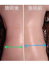 フロレゾン(Floraison)/背中集中施術！お任せ下さい