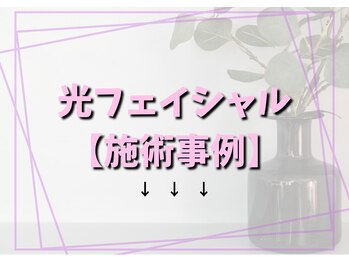 キュー(cue)/光フェイシャル
