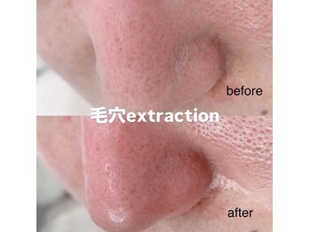 ペタルカ(petalca)/毛穴エクストラクション