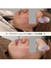 ディアー(Dear)/プラズマパールリフト