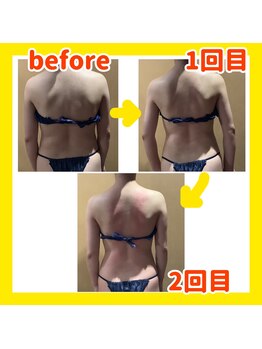 ビタミンスパ アンド ボーテ 三軒茶屋店/かっさ痩身ビフォーアフター写真